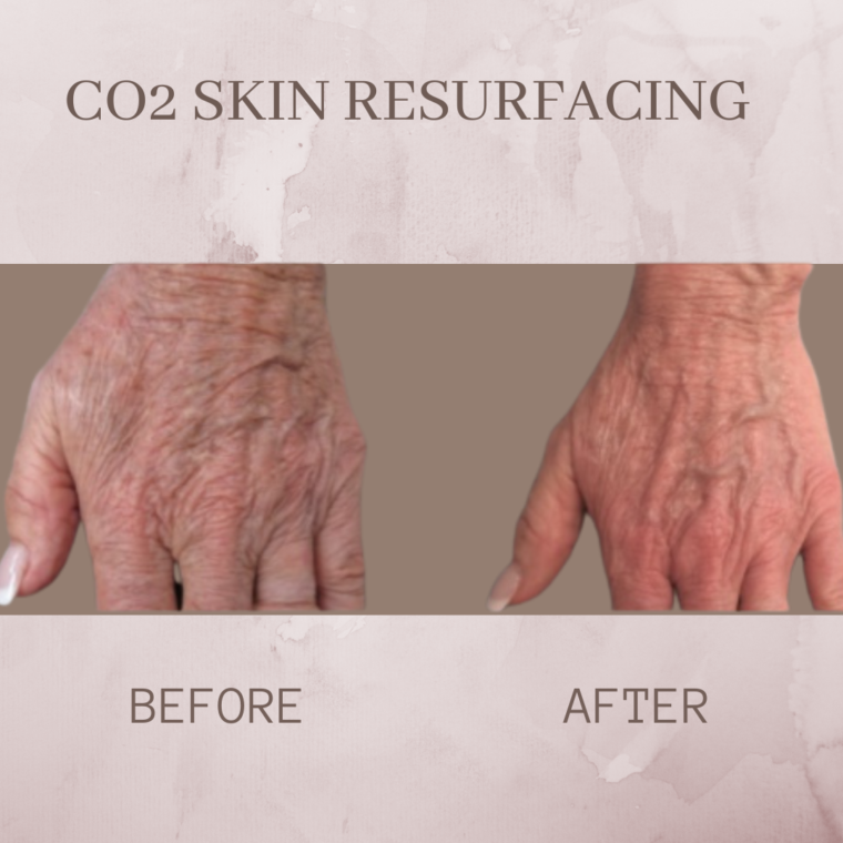 Co Resurfacing Eluma Laser Aesthetics