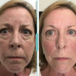 Cheek filler before and after jacksonville florida