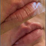 Versa lip filler before and after jacskonville florida