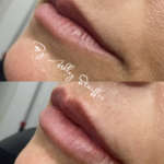 Versa lip filler before and after jacskonville florida
