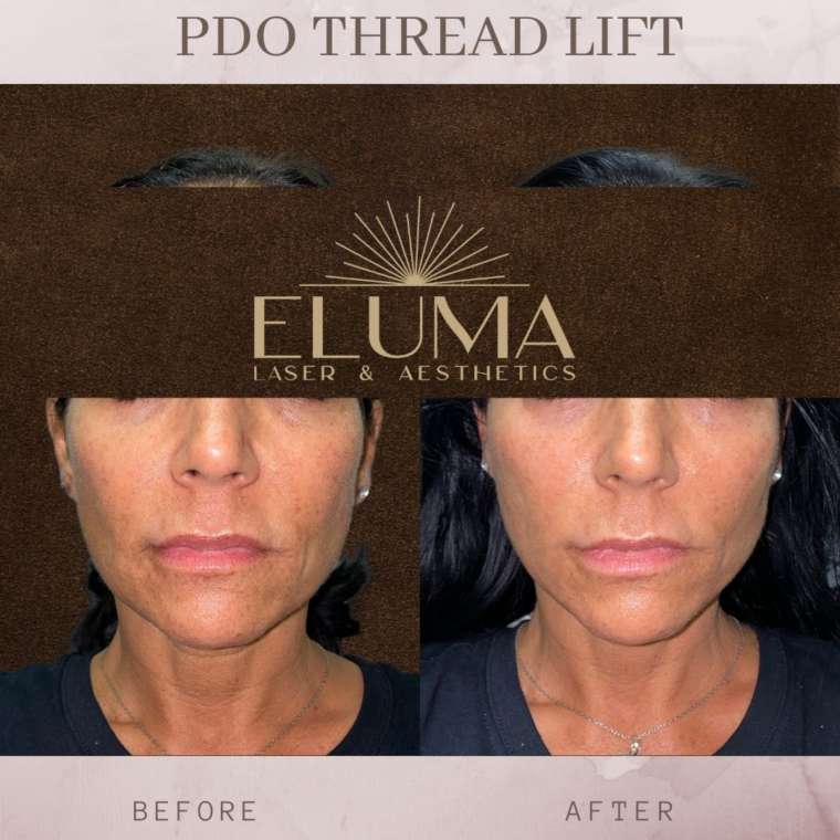 Pdo Thread Lift Eluma Laser And Aesthetics