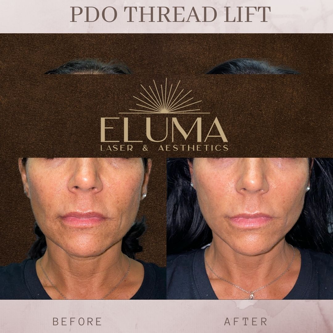 PDO thread lift before and after jacskonville florida