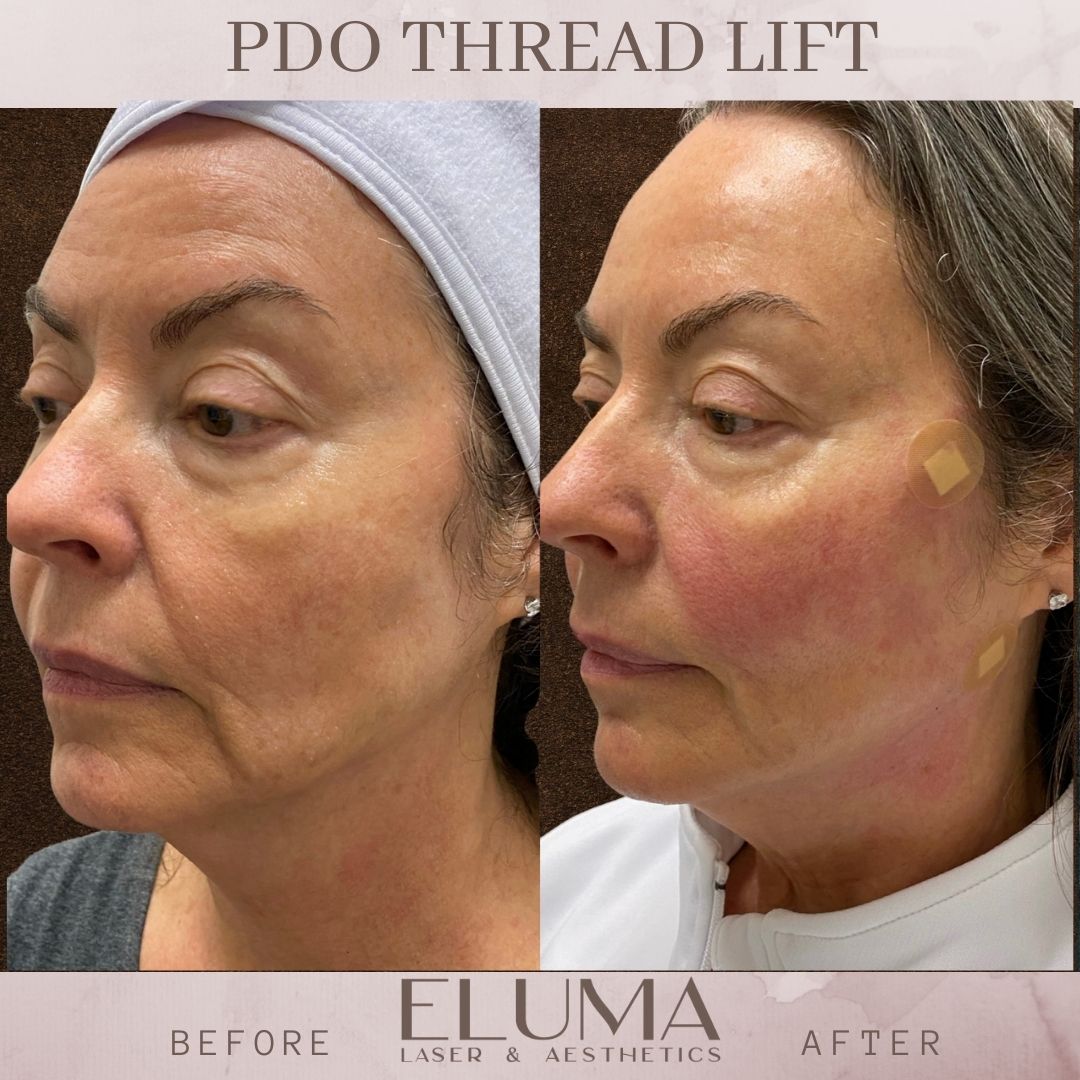 PDO thread lift before and after jacskonville florida