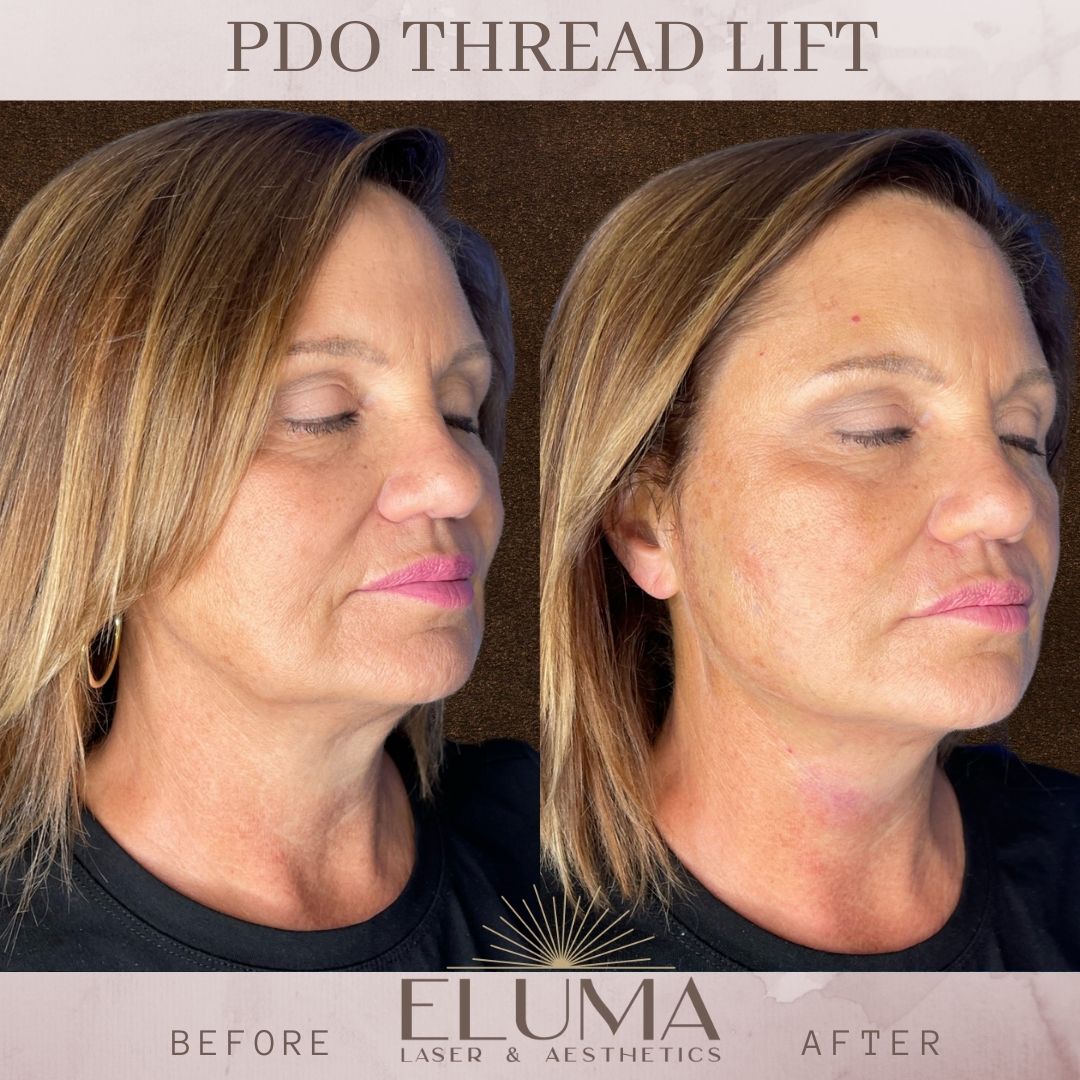 PDO thread lift jowls before and after jacskonville florida