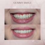 gummy smile before and after jacksonville florida