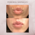 perioral wrinkles before and after
