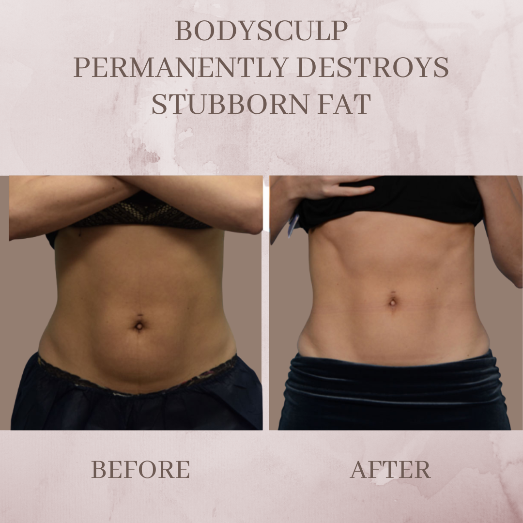 Body-sculp before and after body contouring