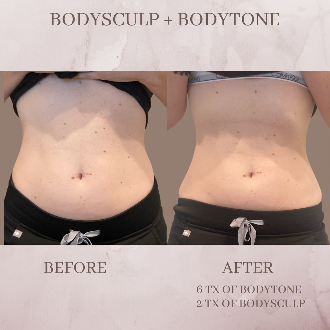 bodysculp and bodytone before and after jacksonville florida body contouring