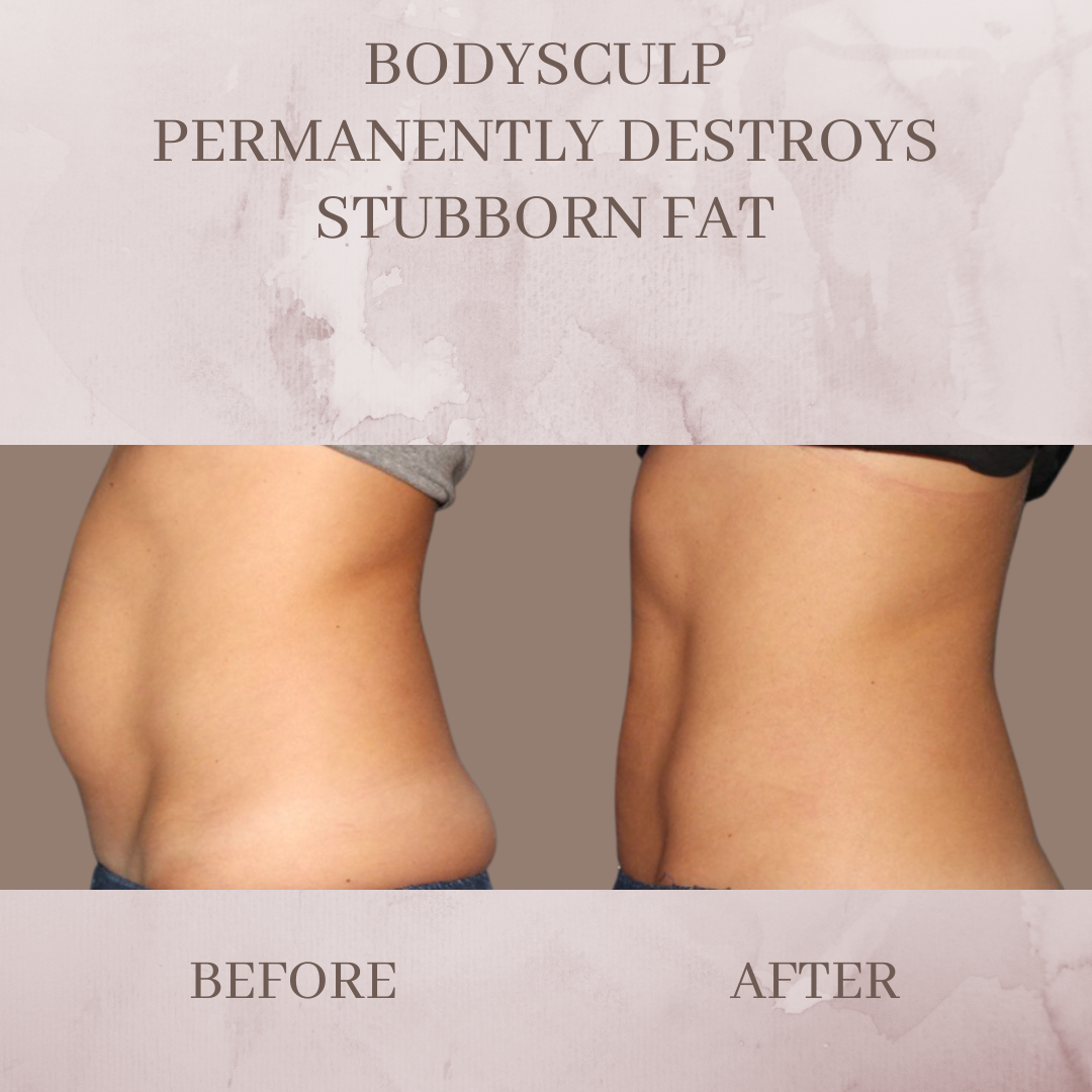 Body-sculp before and after body contouring