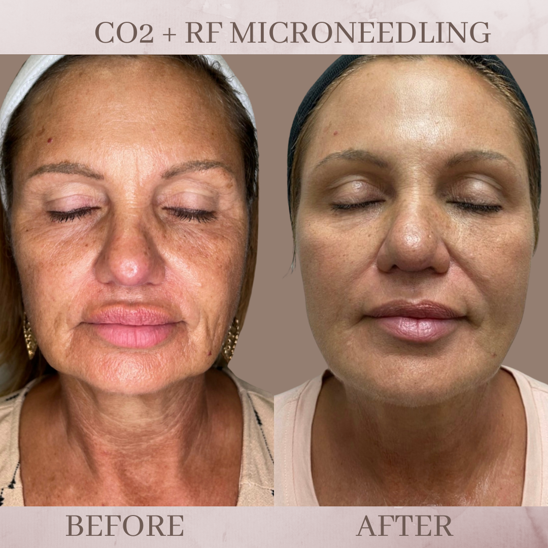 CO2 + RF Microneedling before and after