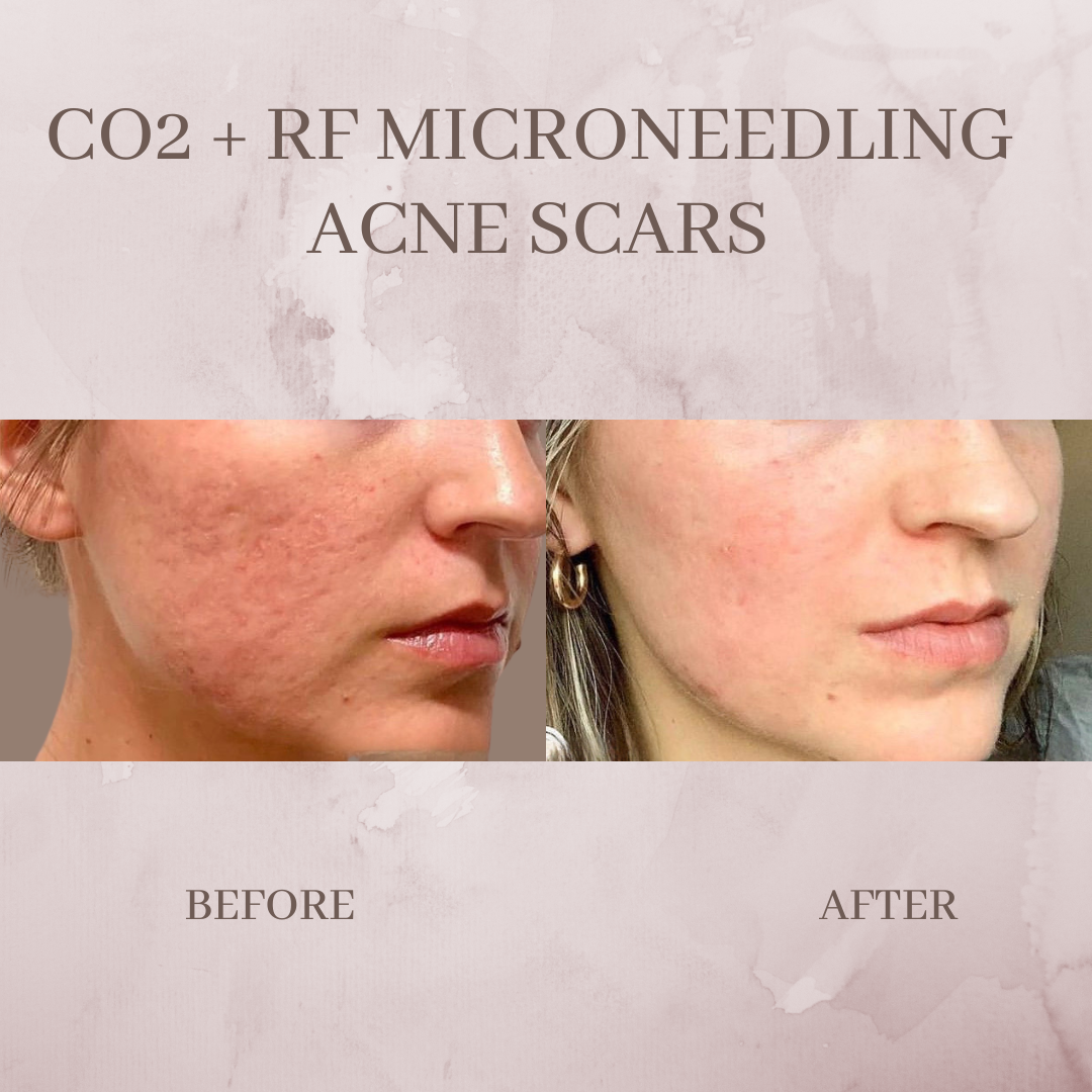 CO2 + RF Microneedling acne before and after jacksonville florida