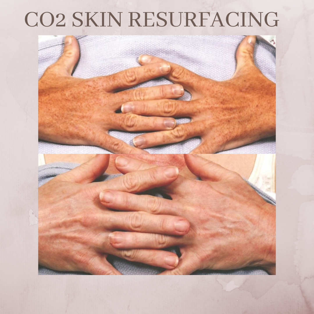 CO2 resurfacing hands before and after