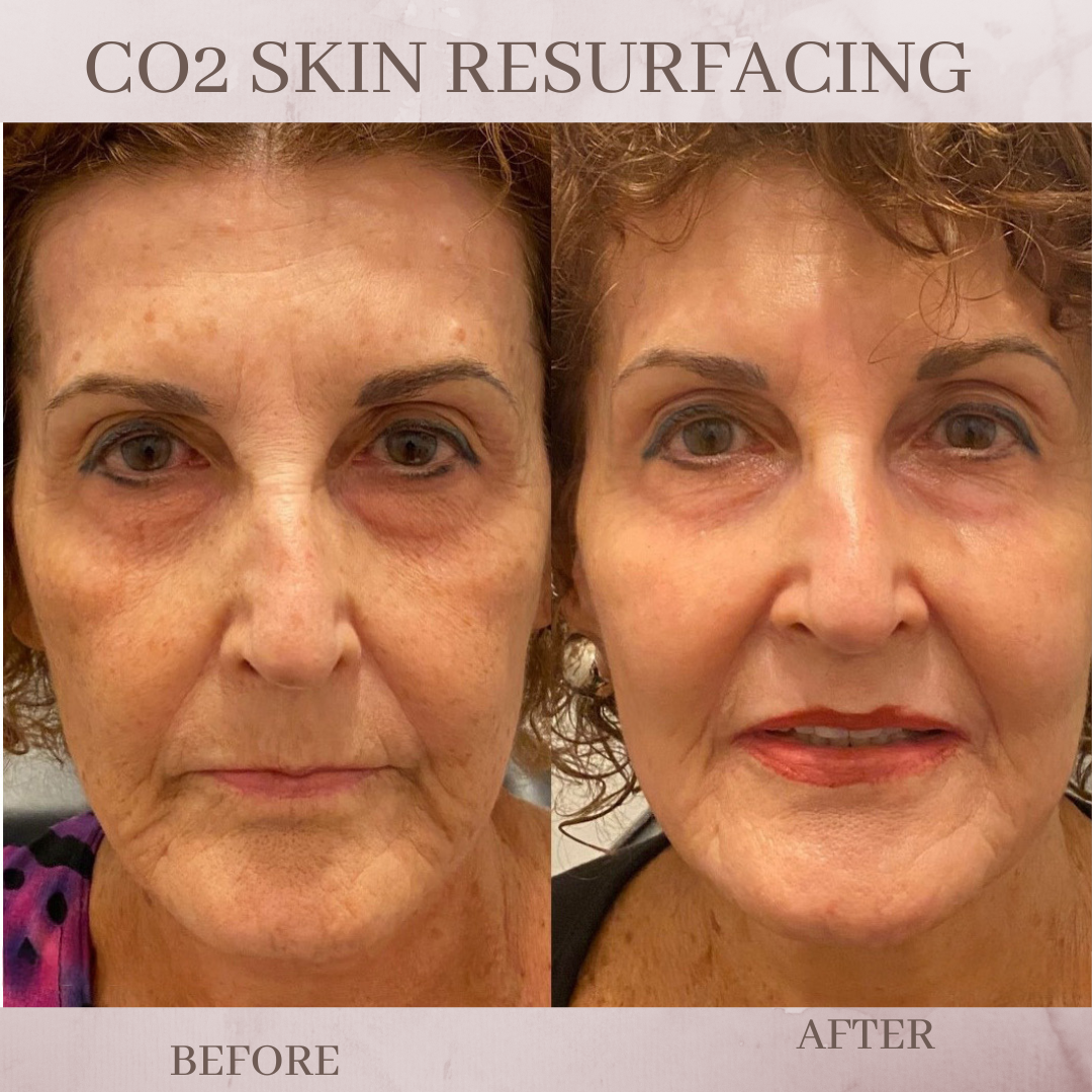 CO2 resurfacing face before and after