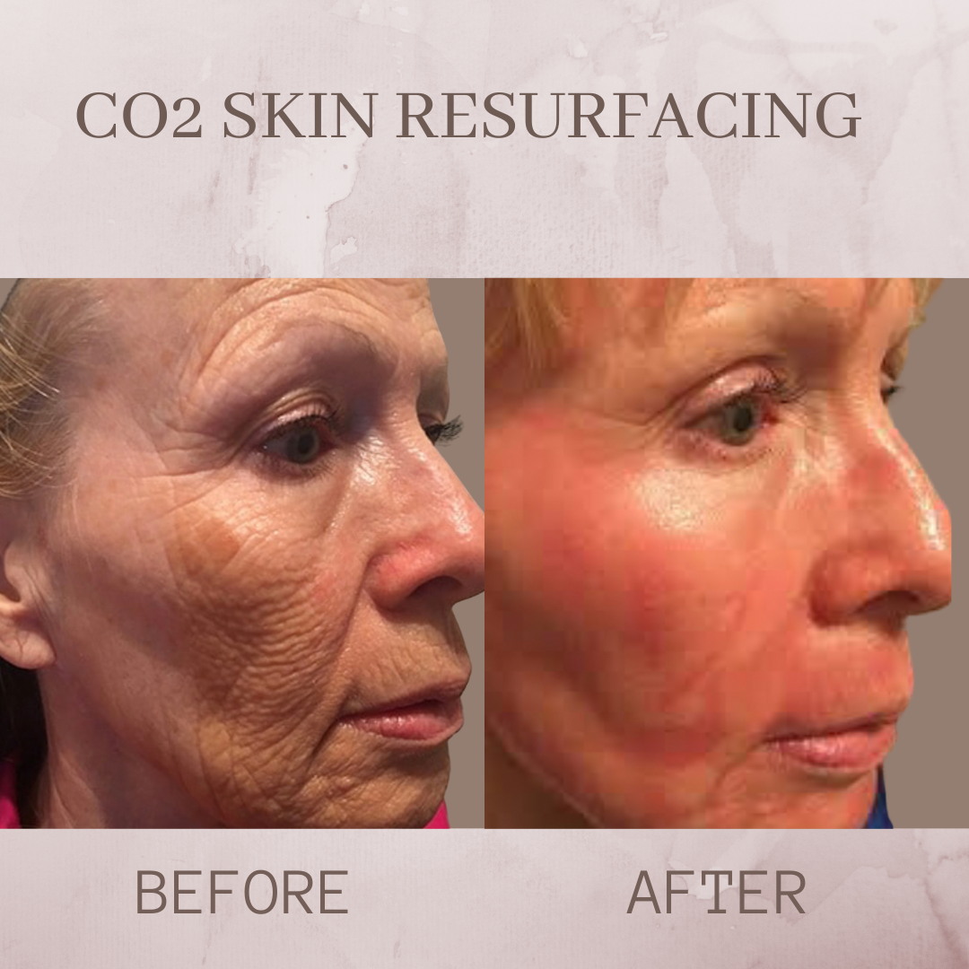 CO2 resurfacing face before and after