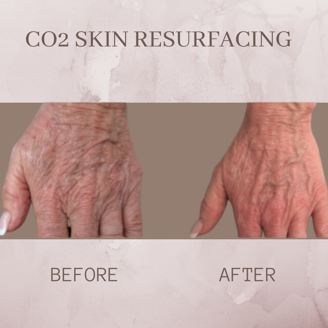CO2 resurfacing hands before and after