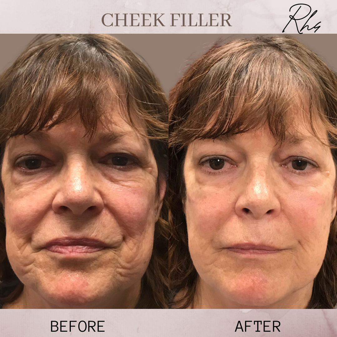 RH4 Cheek Filler before and after jacksonville florida