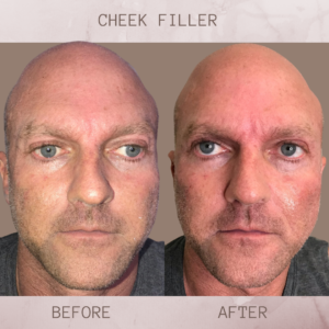 Cheek Filler Eluma Laser Aesthetics