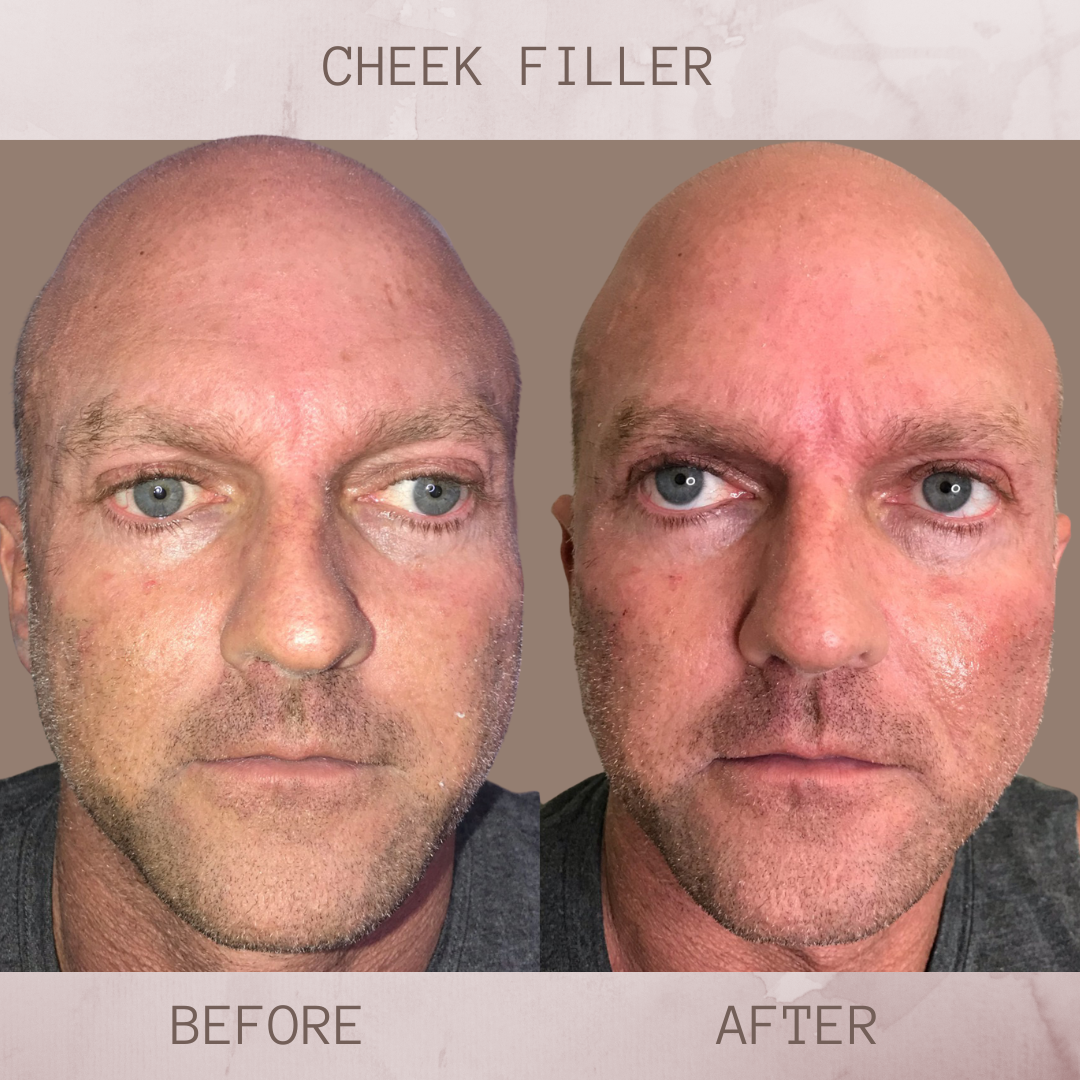 Cheek Filler before and after jacksonville florida