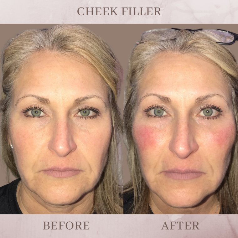 Cheek Filler Eluma Laser And Aesthetics 5145