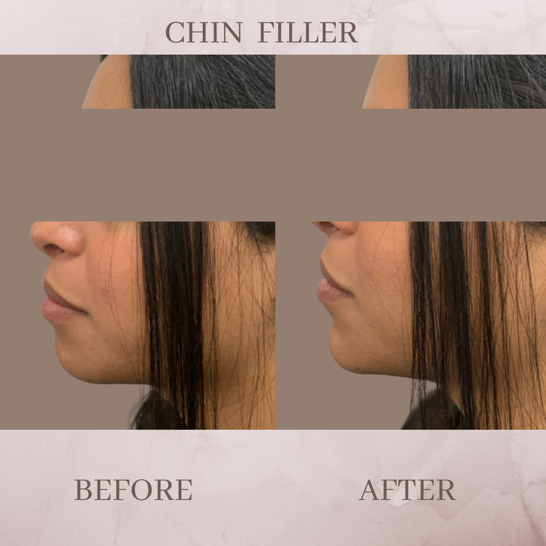 chin filler before and after jacksonville fl