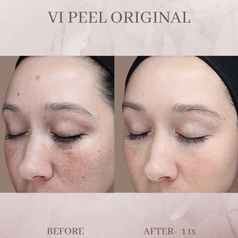 Vi Peel Eluma Laser And Aesthetics 5292