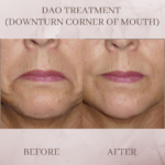 botox before and after xeomin before and after dysport before and after