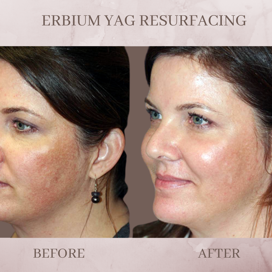 Erbium yag skin resurfacing before and after pictures