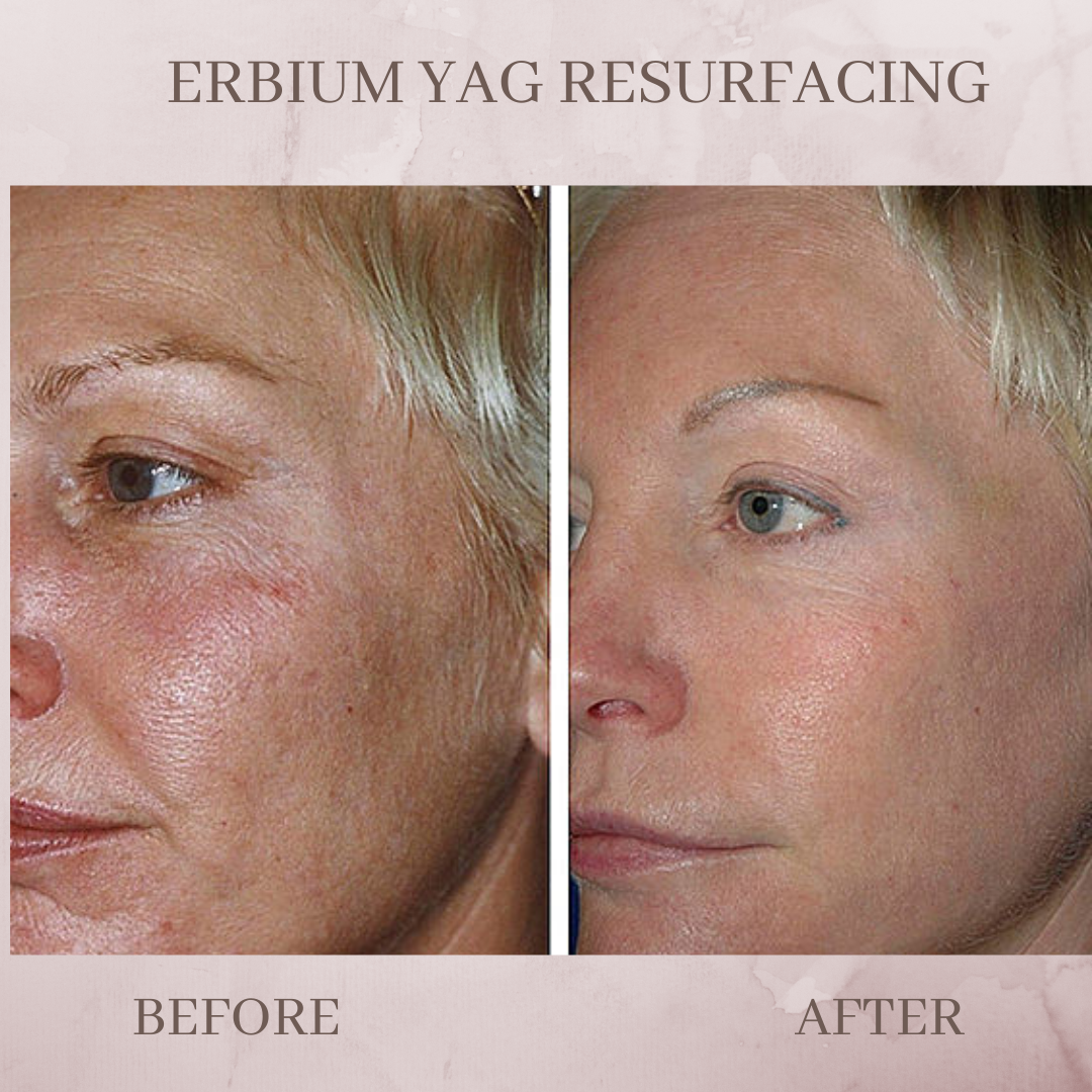 Erbium yag skin resurfacing before and after pictures