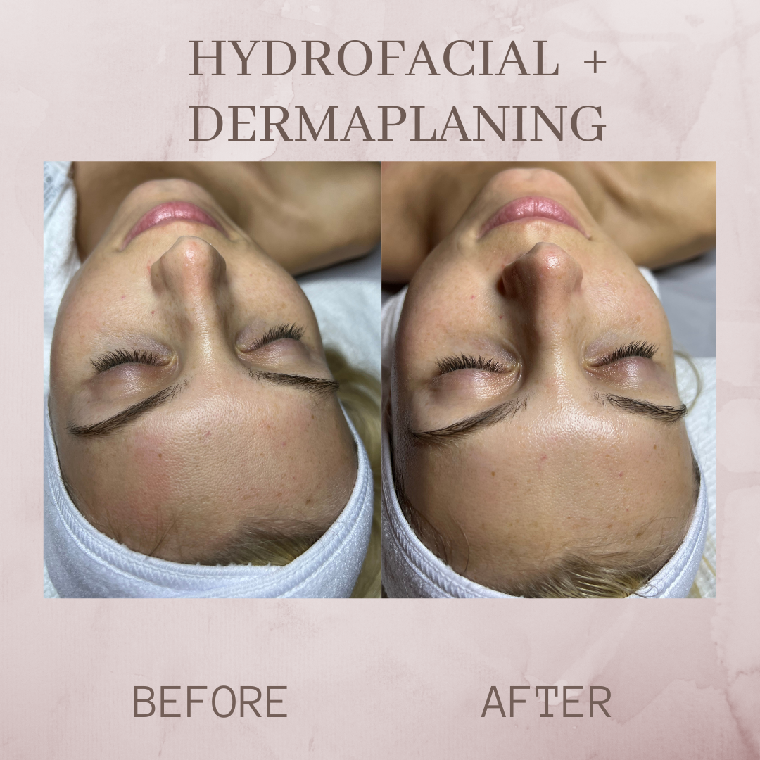 Hydrofacial before and after photo