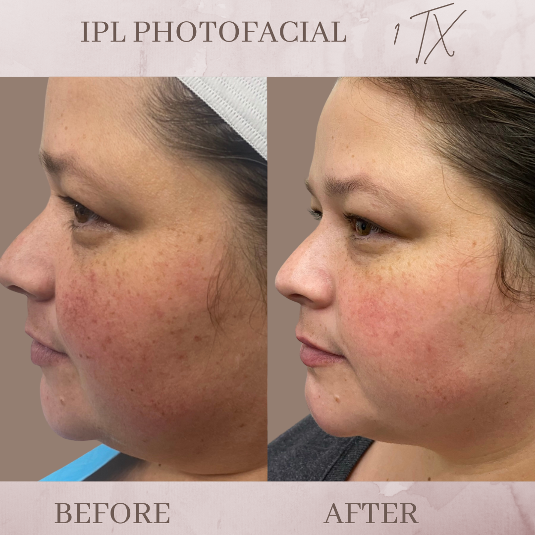 IPL Photofacial before and after