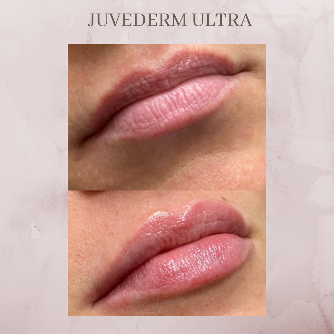 Juvederm Ultra lip filler before and after jacksonville florida