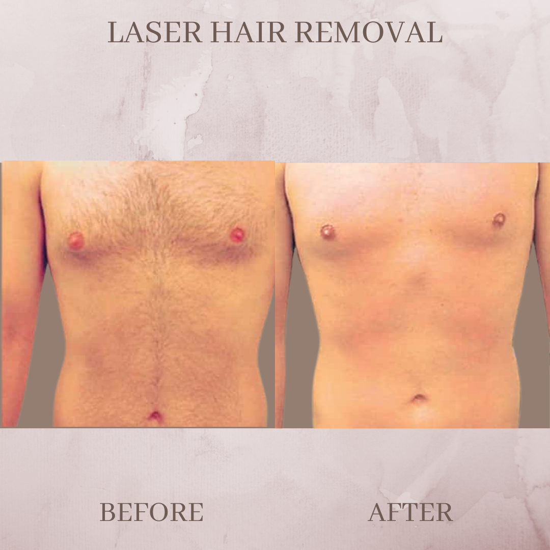 Laser hair removal before and after jacksonvile florida