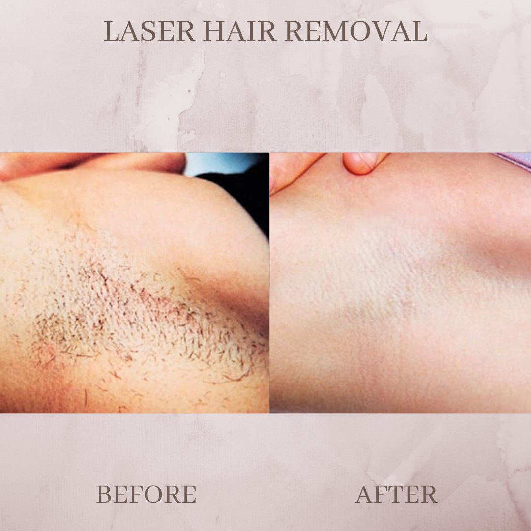 Laser hair removal before and after jacksonvile florida