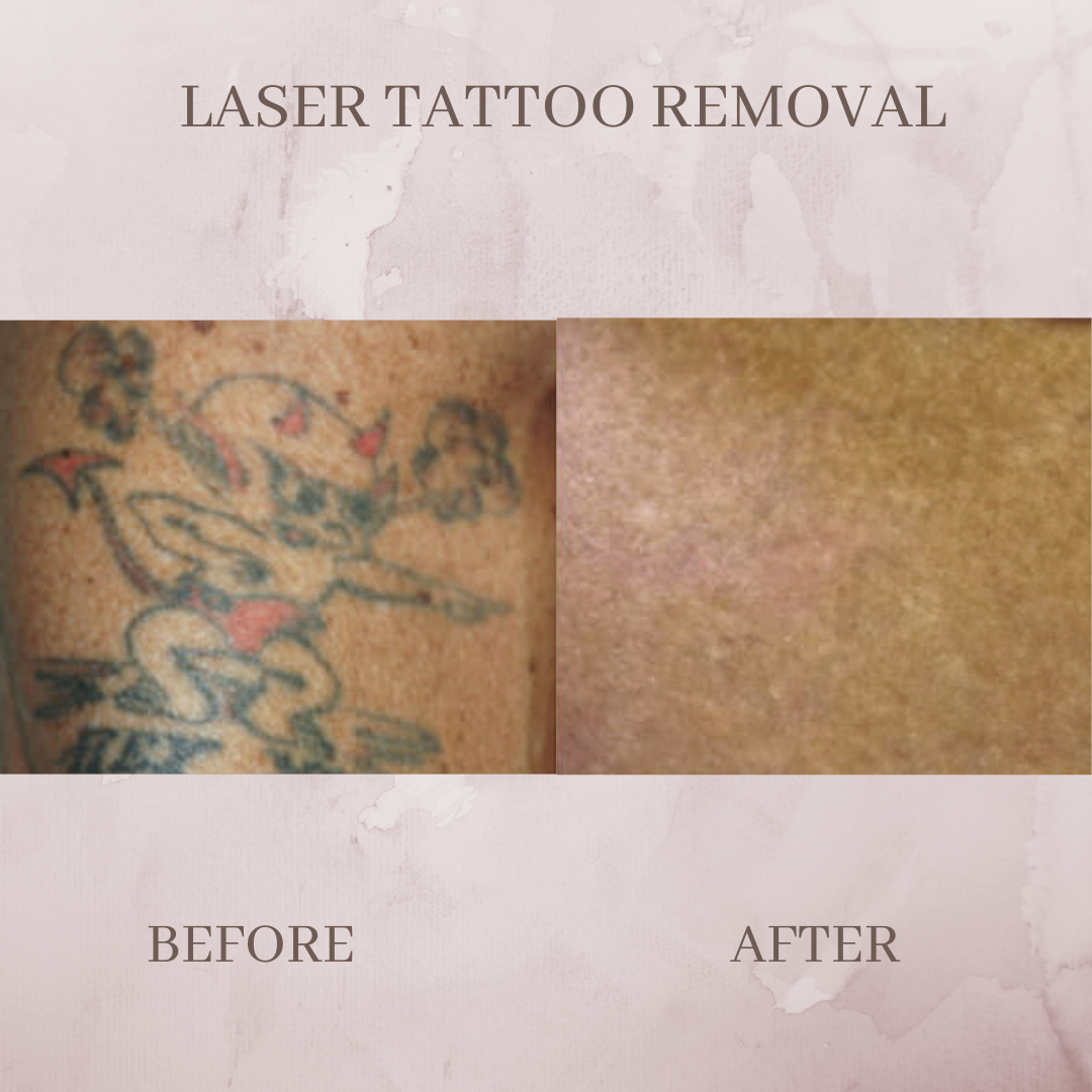Tattoo removal jacksonville florida