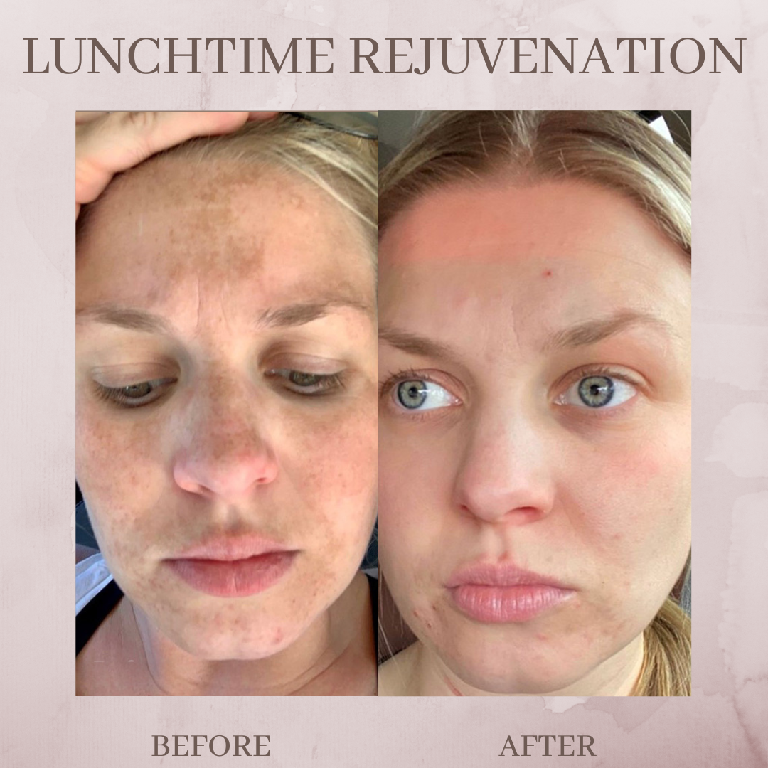 lunchtime rejuvenation before and after jacksonville florida melasma treatment