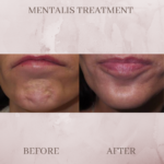 Botox before and after xoemin before and after dysport before and after