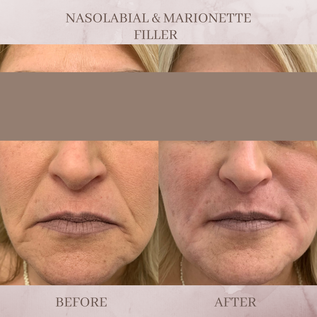Nasolabial Fold filler before and after Marionette line filler before and after