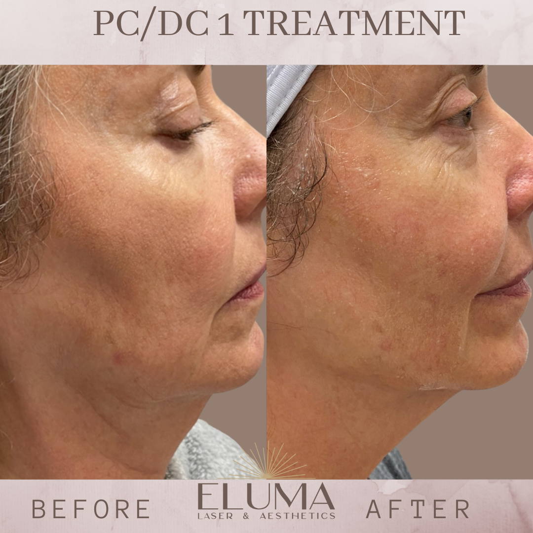 kybella before and after jacksonville florida pc/dc before and after jacksonville florida Double chin reducer before and after