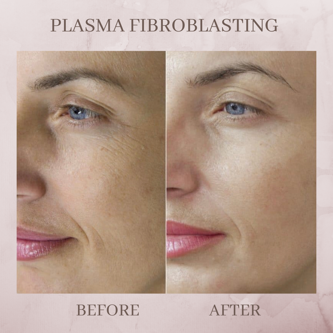 Plasma pen before and after jacksonvillve fl