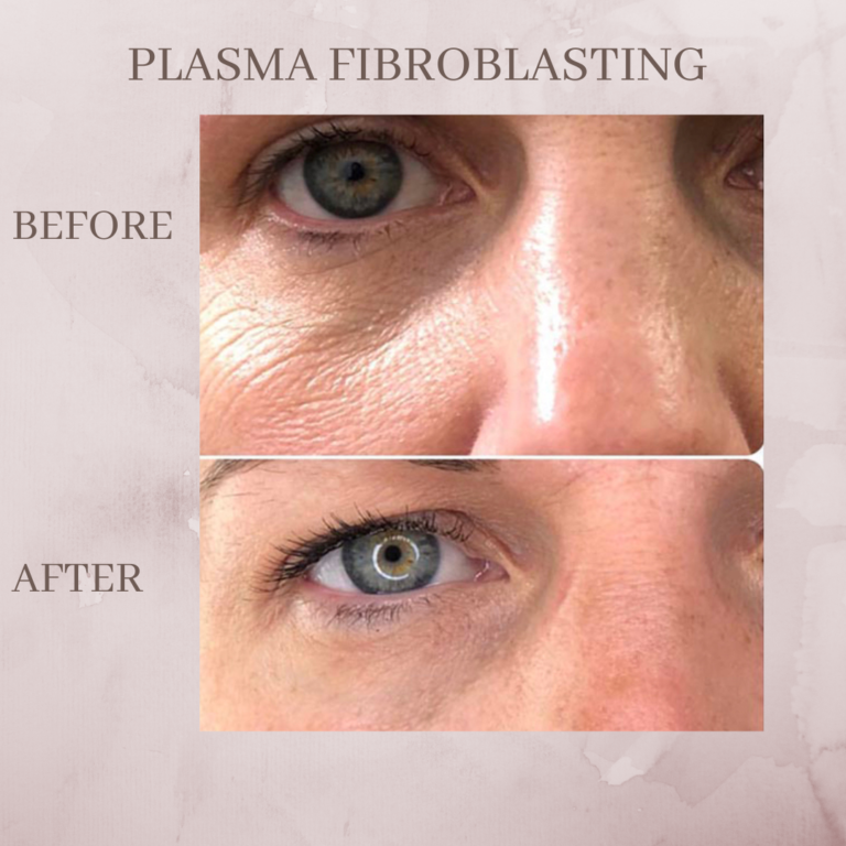 Plasma Pen Eluma Laser And Aesthetics