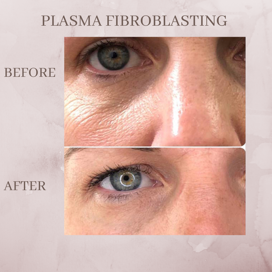 Plasma pen before and after jacksonvillve fl