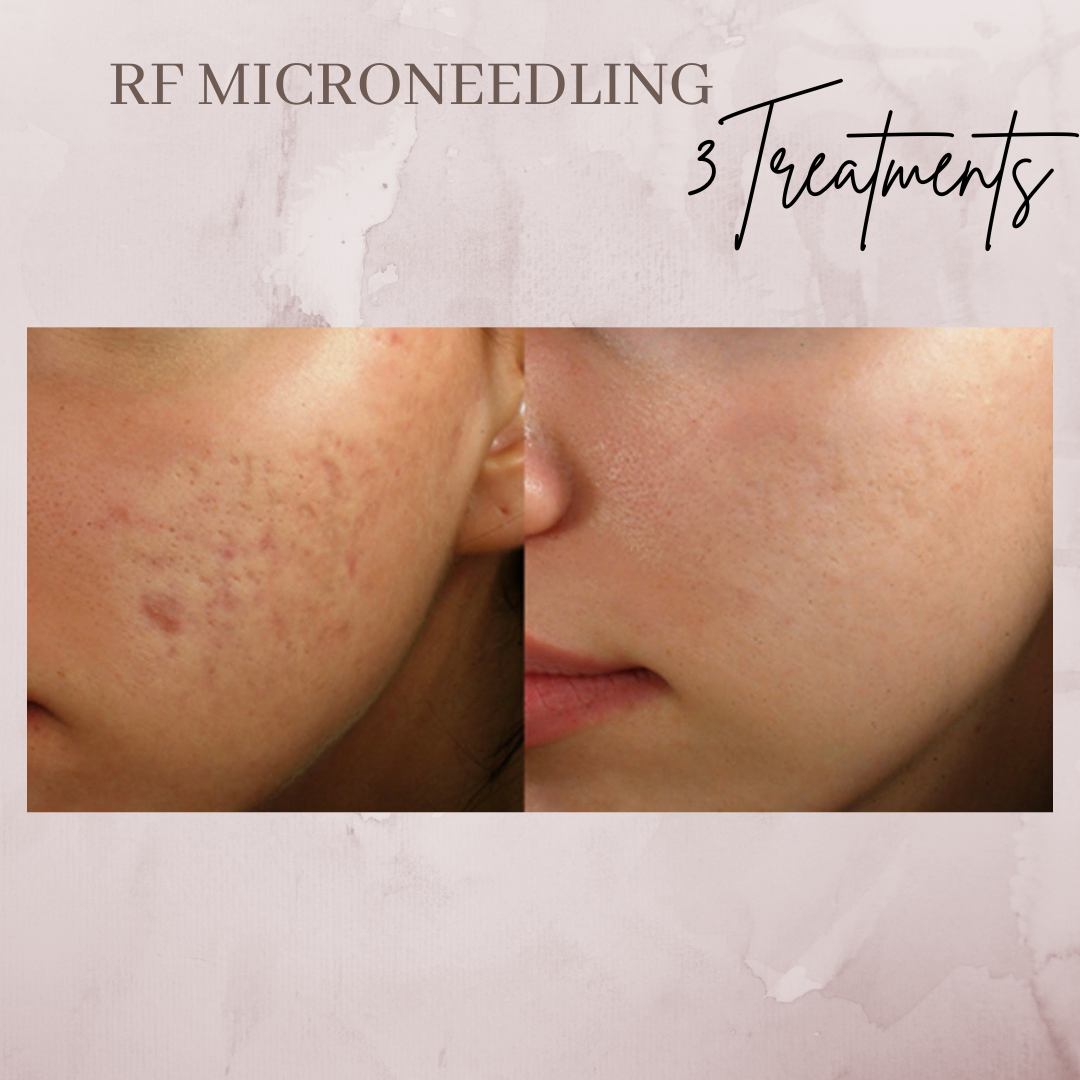 RF-microneedling acne before and after jacksonville florida