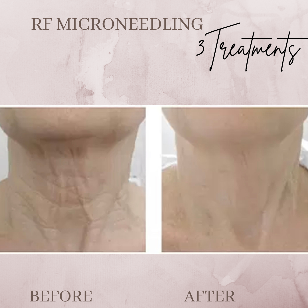 RF-microneedling wrinkles laxity before and after jacksonville florida