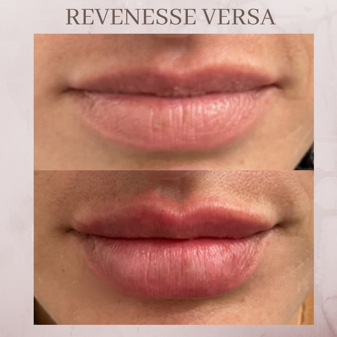 Revenesse Versa lip filler before and after jacksonville florida