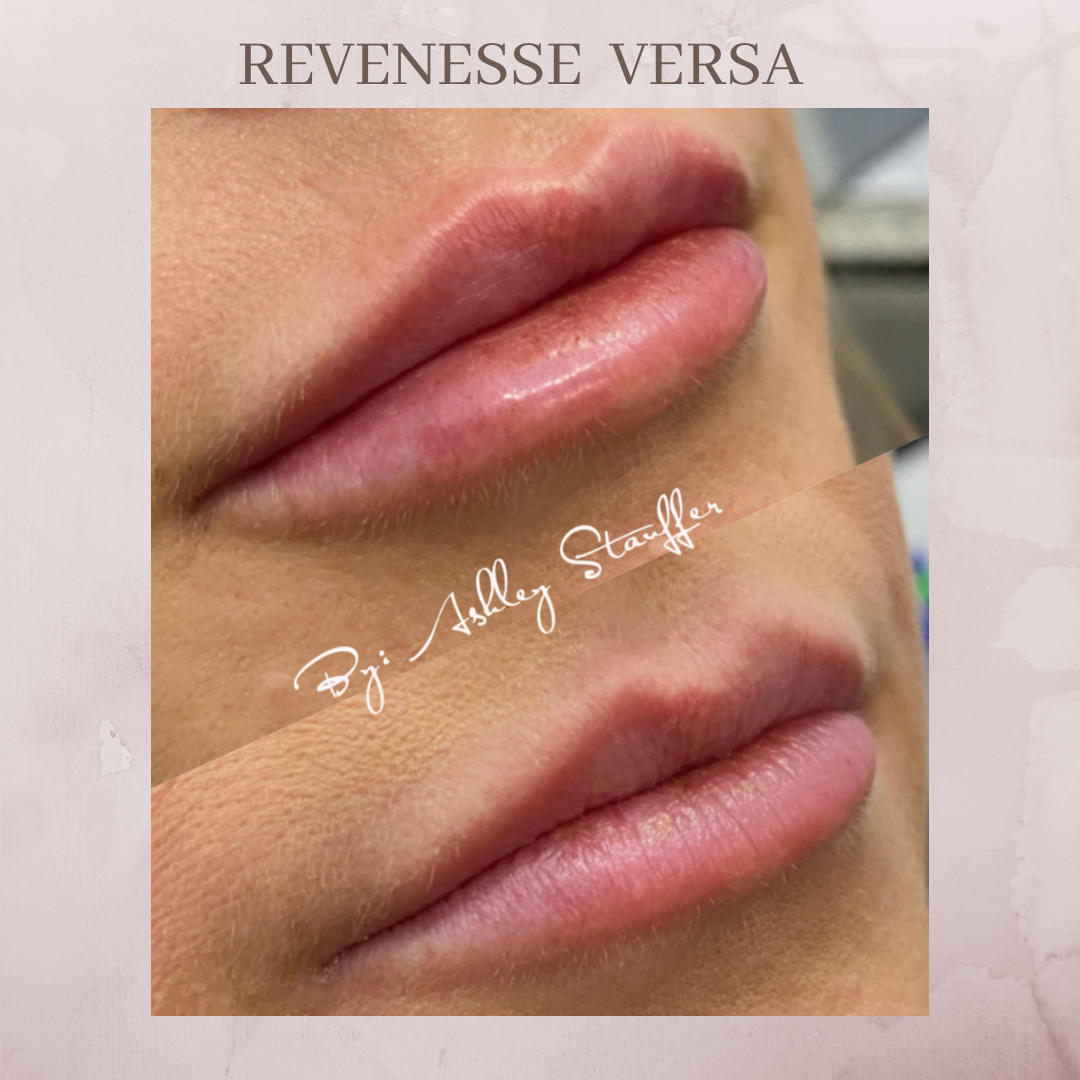 Revenesse Versa lip filler before and after jacksonville florida