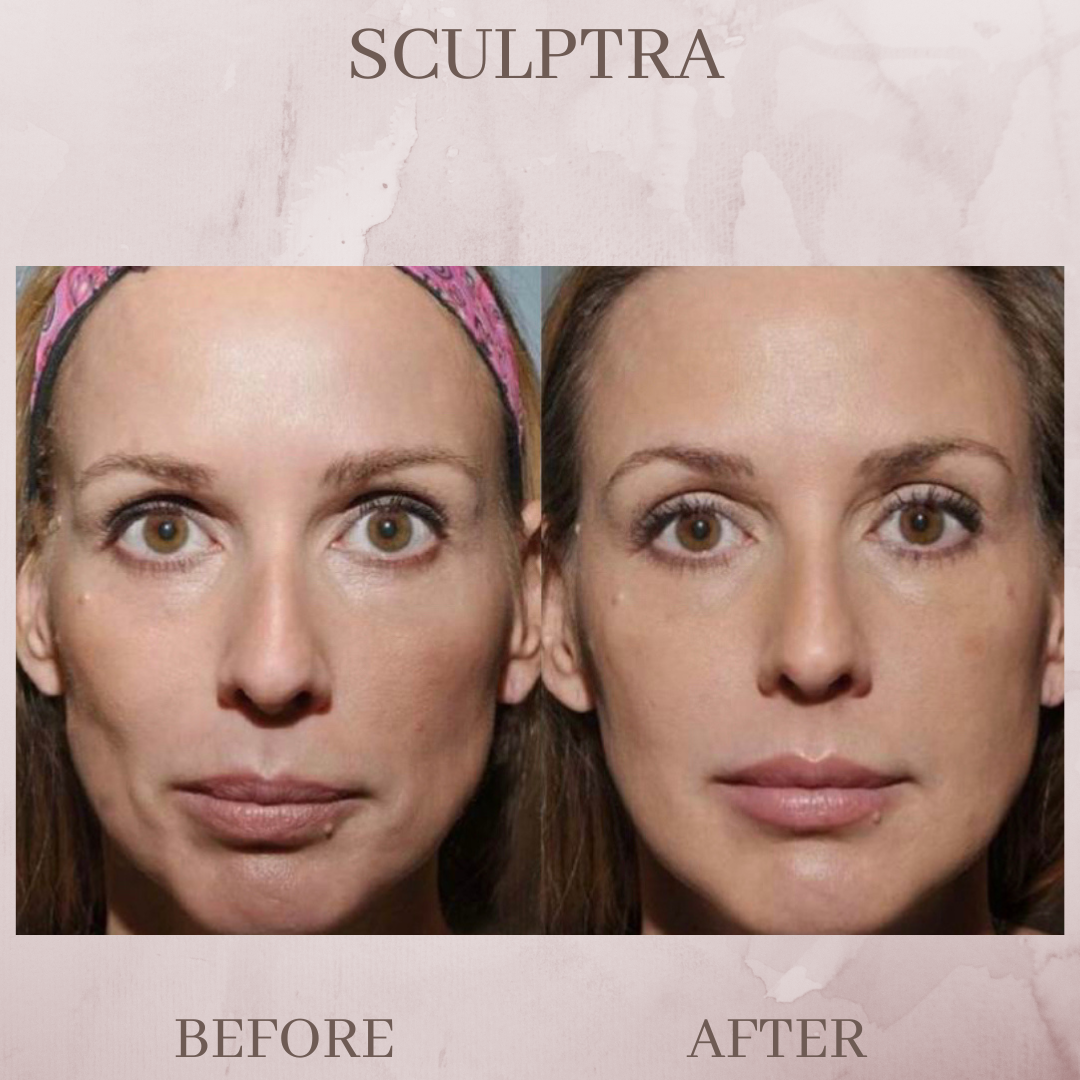 Sculptra before and after jacksonville florida