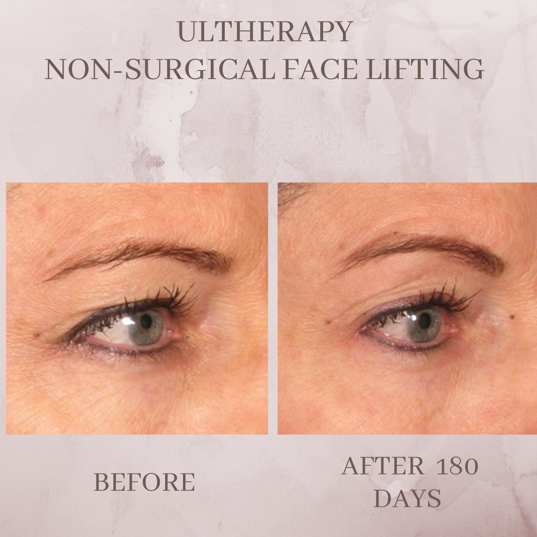 Ultherapy brow lift eyelid tightening before and after Jacksonville Florida