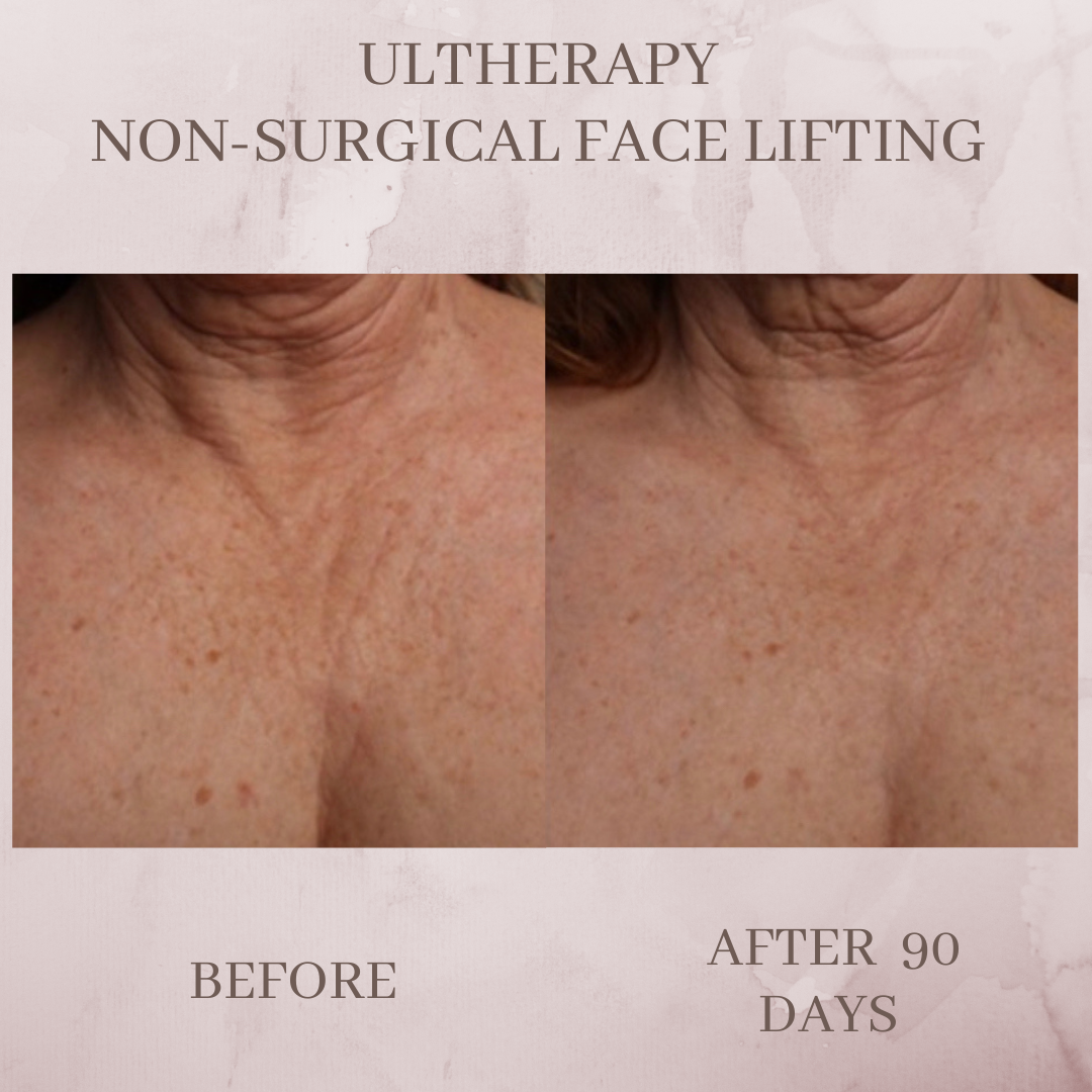 Ultherapy chest before and after Jacksonville Florida
