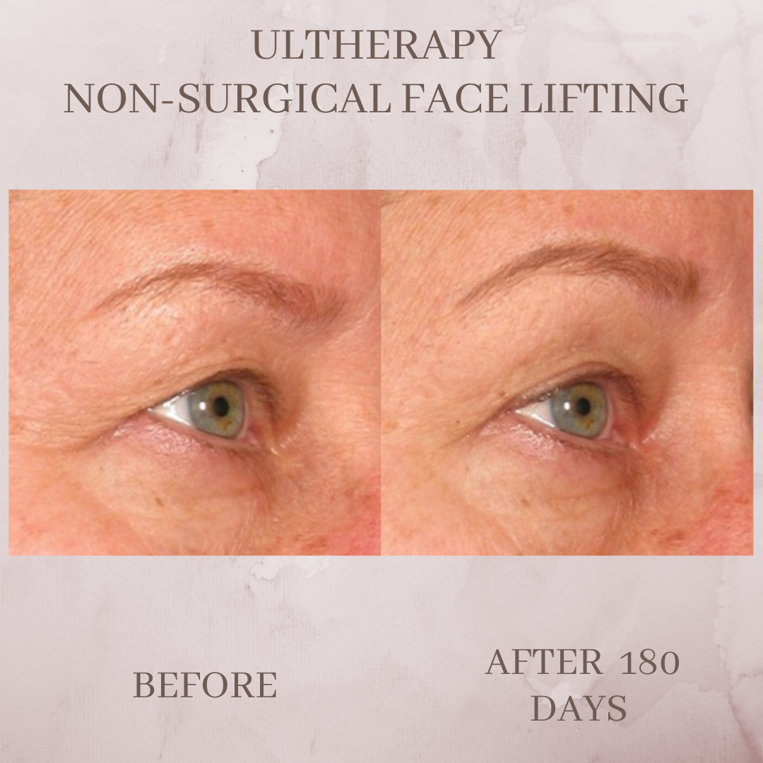 Ultherapy brow lift eyelid tightening before and after Jacksonville Florida