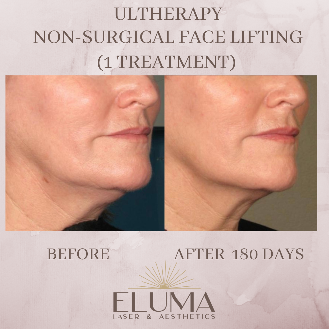 Ultherapy lower face jawline before and after Jacksonville Florida